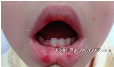 手足口病症状初期图片,口腔黏膜/嘴唇/手掌等部位会出现红色丘疹