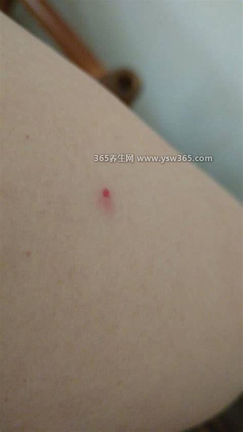 HPV初期小红点照片图片长在哪里,长在YD/阴唇/肛门或子宫颈