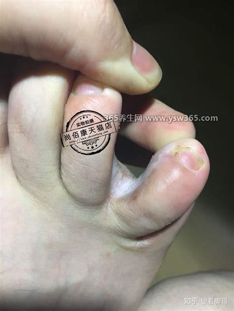 三种类型脚气的图片及症状,水疱型/角化型/糜烂型(角化型最难治)