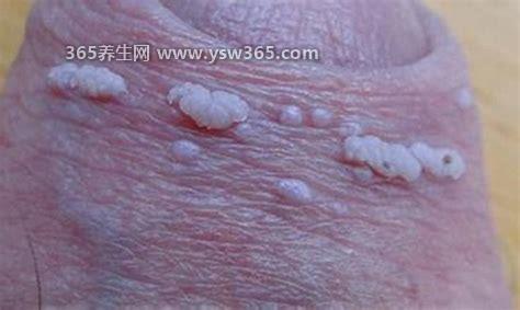 真实男女下面尖湿锐早期图片,早期是米粒大小的疣体/微红或污红