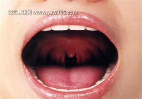 警惕喉癌的5大早期症状图片,发现咳嗽/痰中带血/声音嘶哑要及时诊治