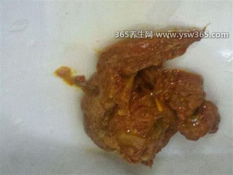 早期肠癌大便图片,大便颜色为暗红黑色就要警惕了