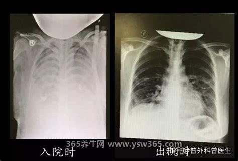 白肺的一个明显表现是气紧还是气松,是气紧/会出现严重缺氧