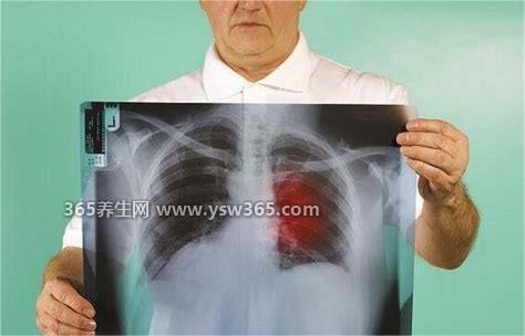 5类人体检尽量别做肺部ct,只建议肺癌高发人群做