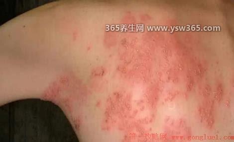 疱疹刚开始症状图片大全,疱疹是病毒感染引起的