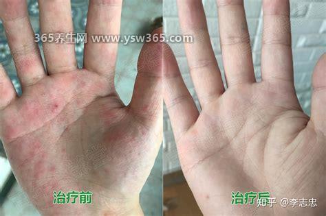 汗疱疹初期图片及症状,往往容易出现在手脚的手指上通常会很痒