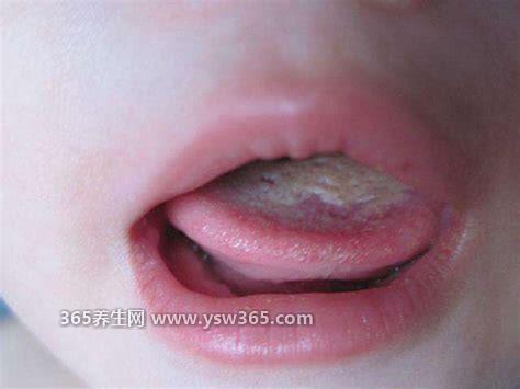 婴儿鹅口疮图片早期症状,严重时甚至导致腹泻/败血症等