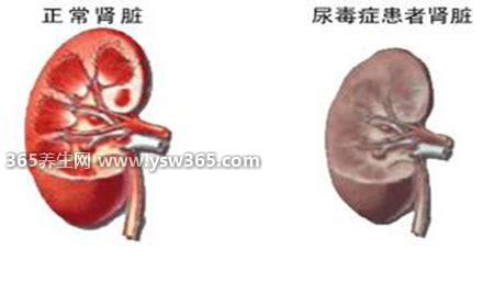 尿毒症早期有8个信号,少尿/恶心呕吐/水肿/乏力/出血等症状