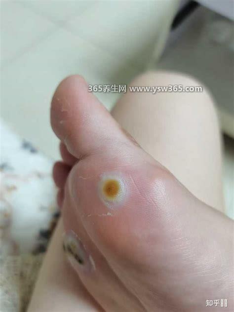 鸡眼是长什么样的图片,鸡眼形状椭圆形/圆形(淡黄色)