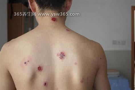 汗疱疹是艾滋病初期症状吗,并不是/与艾滋病完全不同