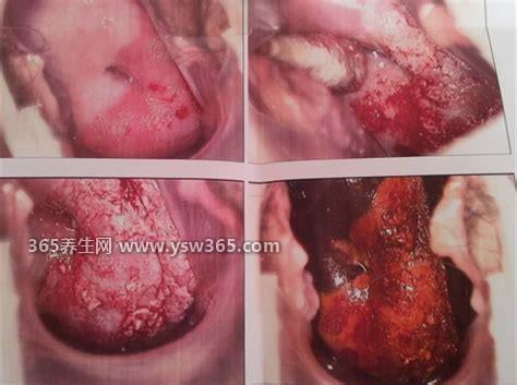 教你几招宫颈癌1分钟自测,尿频/腹部不适/出血等就要重视了