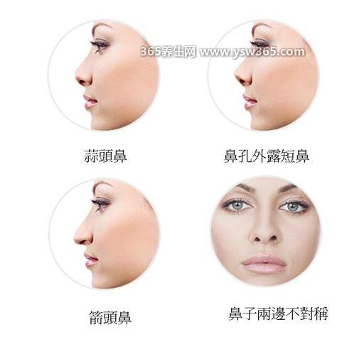 标准蒜头鼻图片,这种鼻子看起来很扁/鼻翼又宽又厚