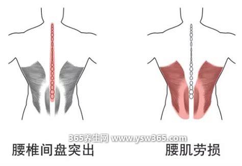 腰肌劳损疼痛位置图主要症状,分别是腰中部疼痛或腰两侧疼痛