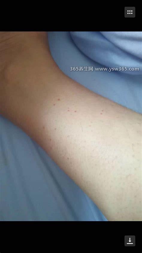 艾滋病初期小红点照片,可能表现为带状疱疹/发病率为27.6%