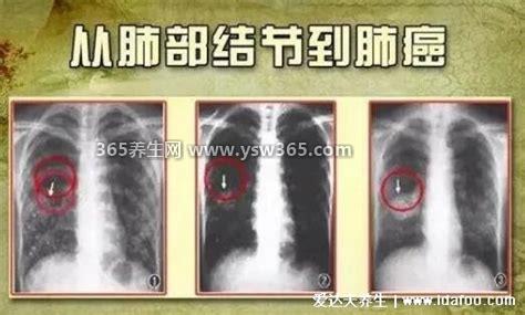 肺部结节最怕三个征兆,警惕生长快的结节/磨玻璃小结节