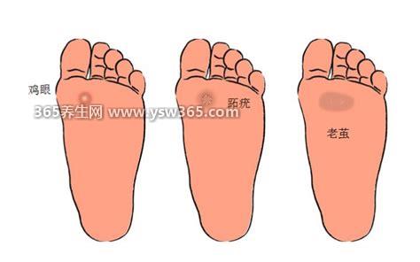 鸡眼和跖疣的区别图片,跖疣比鸡眼危害更大(跖疣有传染性)