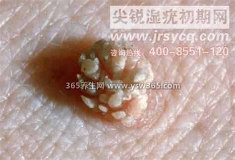 菜花状疣体图片早期症状,刚开始是微小的皮疹颜色微红