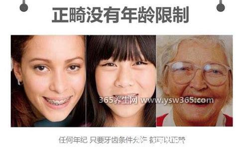 成年以后千万别整牙,费用更高/一般两年以上才会有好的效果