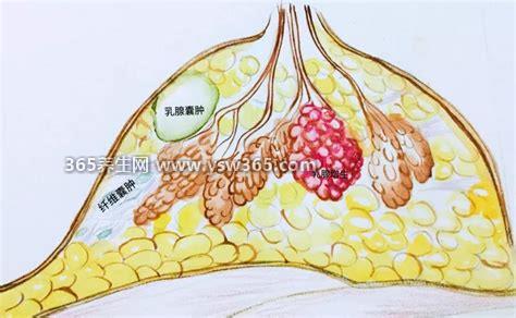 乳腺增生和正常乳腺图片手感,正常乳房柔软有弹性没有异物感
