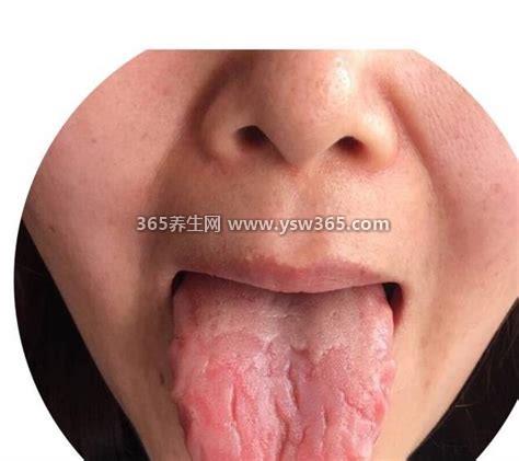 胃癌早期舌头图片,舌头异常与胃癌没有必然联系