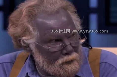 世界上有蓝血人吗,是有的(只是因为疾病而不是天生的)
