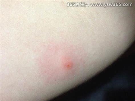 跳蚤咬的红疙瘩图片真实,会出现一条直线或者三角形的红疙瘩