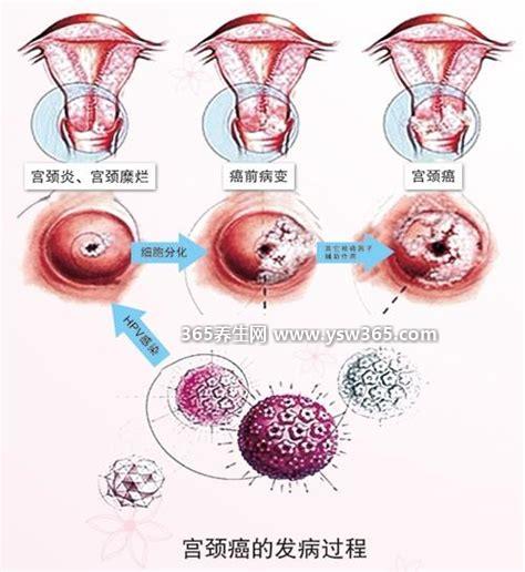 早期宫颈癌的六个信号,面部瘙痒/外阴瘙痒/异常分泌等症状
